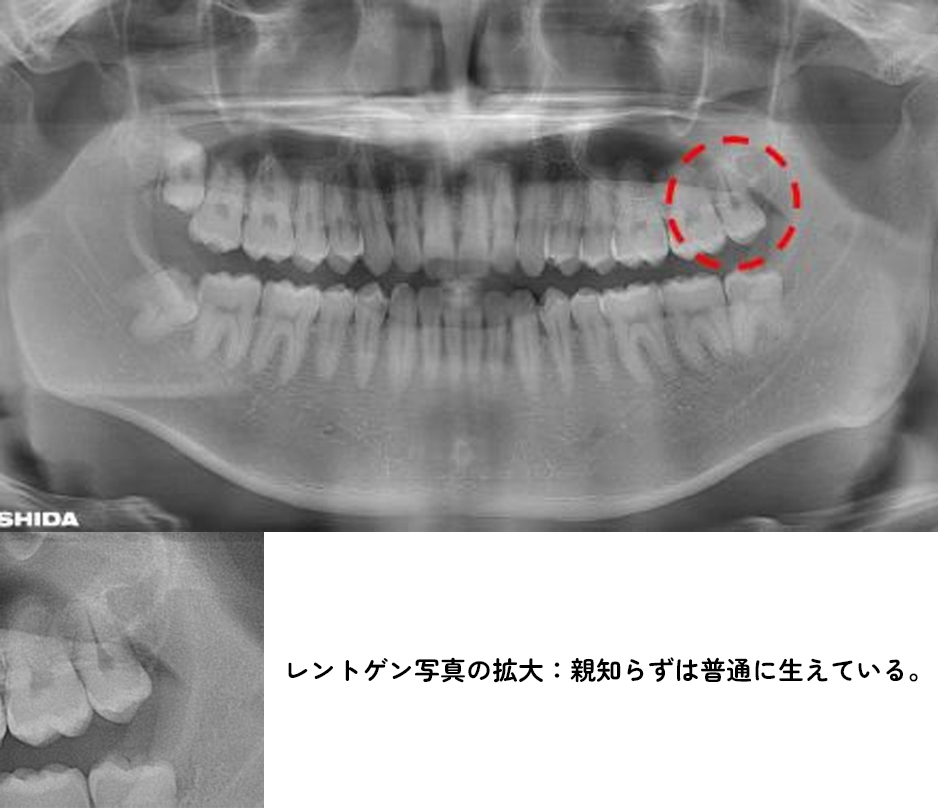 親知らず専門外来症例1