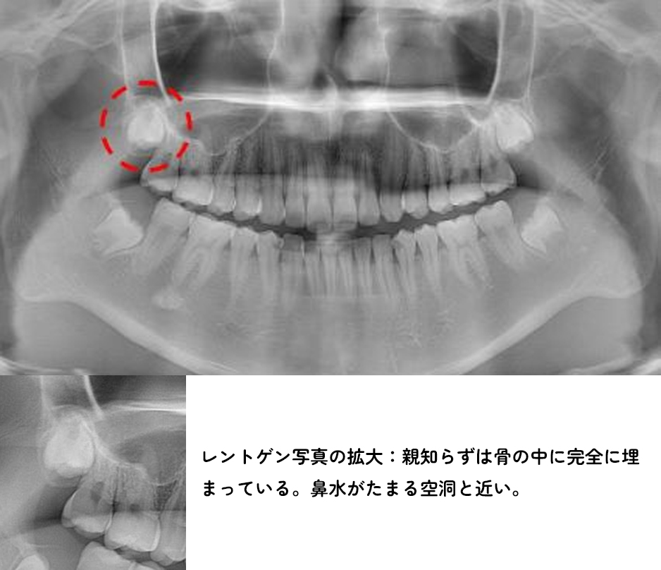 親知らず専門外来症例2