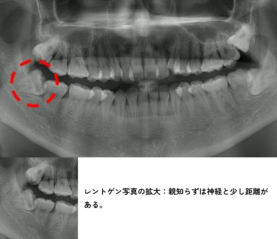 親知らず専門外来症例3